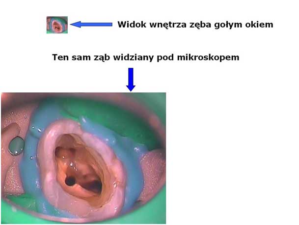 widok wnętrza zęba w powiększeniu